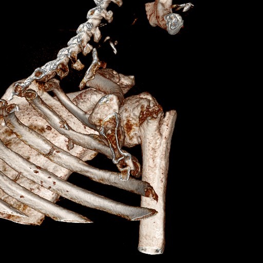КАТ / 3D реконструкция проксимален хумерус - изображение 1