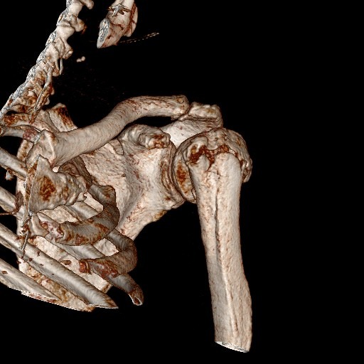 КАТ / 3D реконструкция проксимален хумерус - изображение 3
