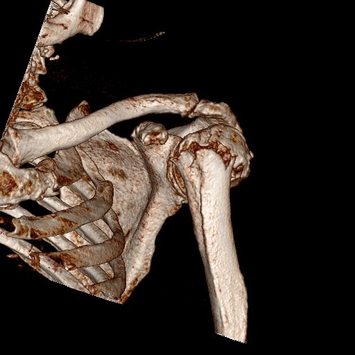 КАТ / 3D реконструкция проксимален хумерус - изображение 4